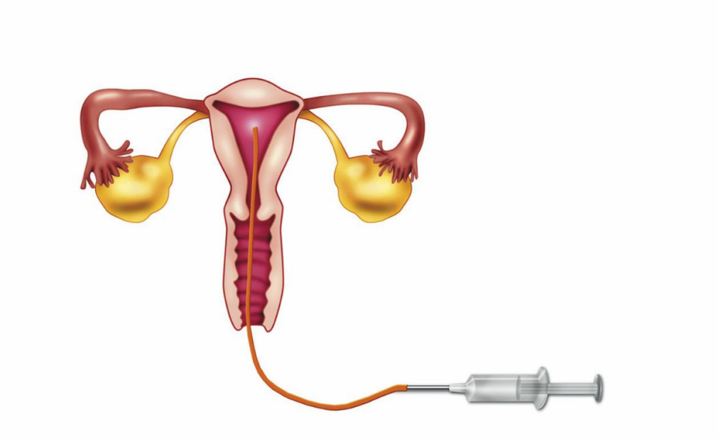如何提高人工授精的成功率 針灸能提高人工授精成功率嗎