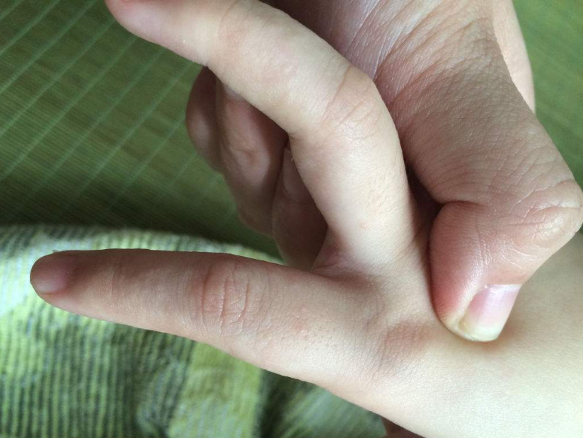 得手足口病的孩子會(huì)恢復(fù)嗎 孩子怎么預(yù)防手足口病2018