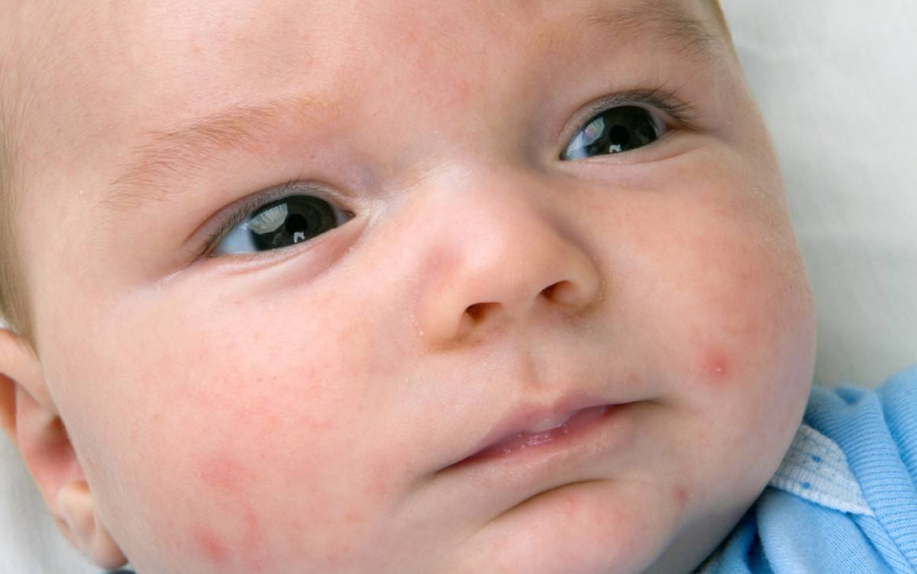 怎么看出寶寶過敏 過敏種類及處理方法2018 怎么看出寶寶過敏 過敏種類及處理方法2018