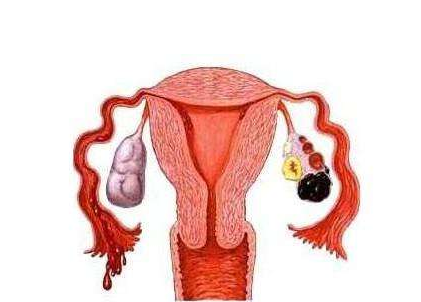 得了巧克力囊腫還能懷孕嗎 得巧克力囊腫的原因是什么