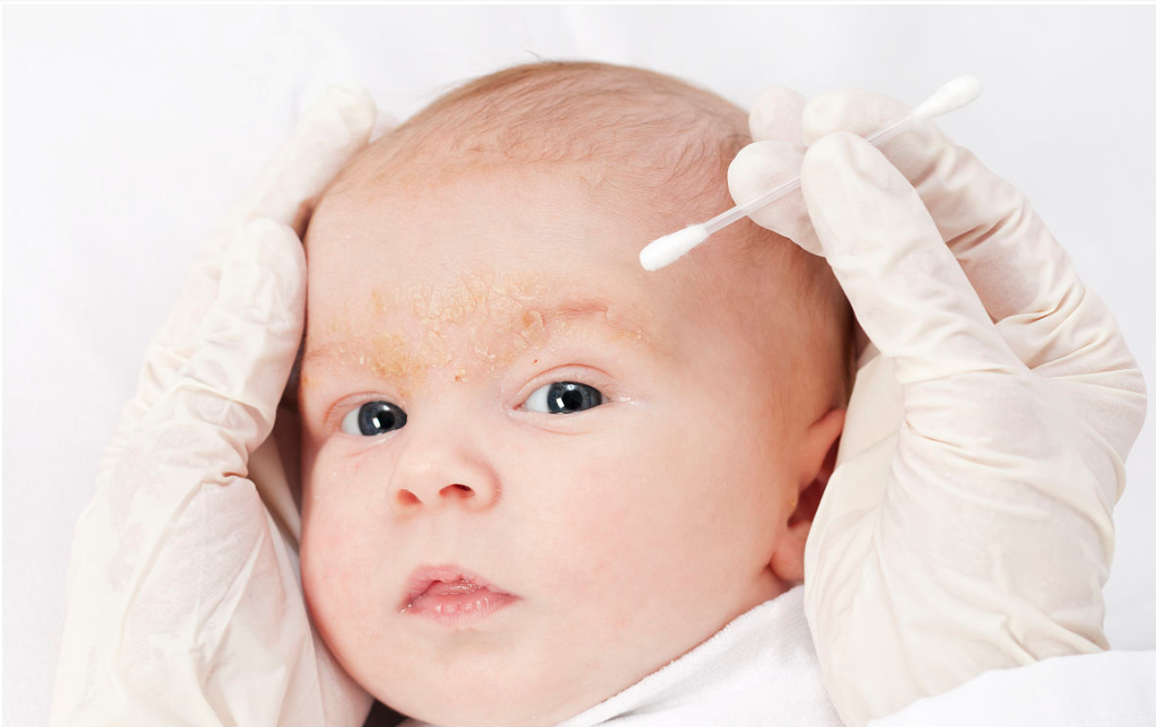 新生兒常見皮膚問題如何分辨 寶寶皮炎怎么護理清潔