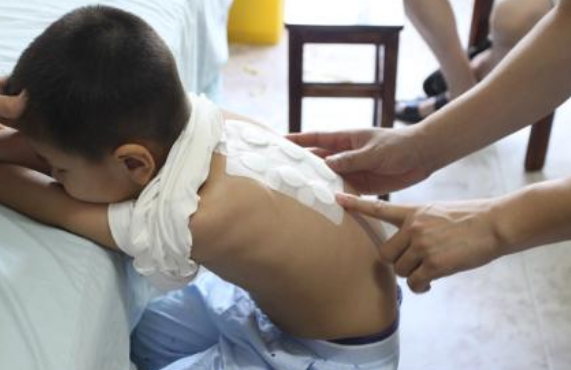 兒童貼三伏貼在哪些穴位好2018 小孩貼完三伏貼要注意什么