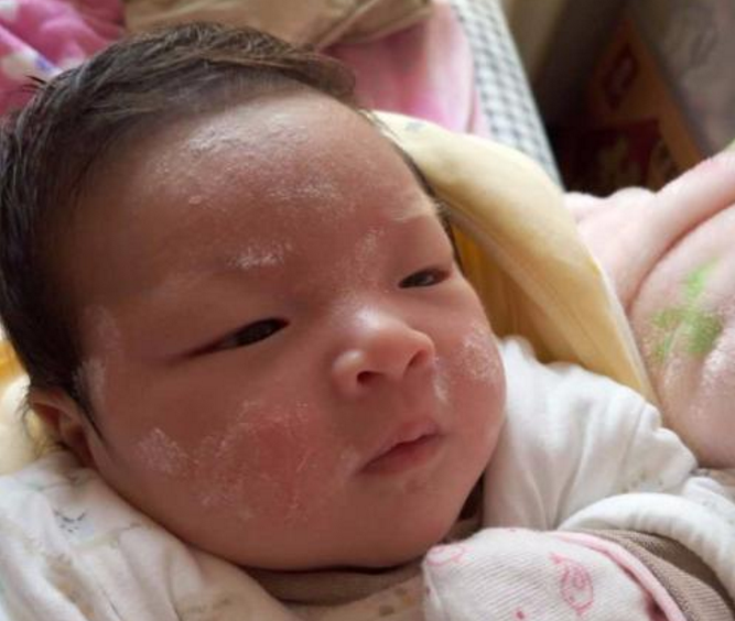 孩子有痱子怎么去痱 預(yù)防孩子長(zhǎng)痱子方法2018