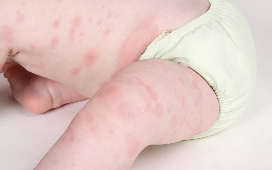 自然產的寶寶比較不會過敏嗎 如何避免生下過敏寶寶