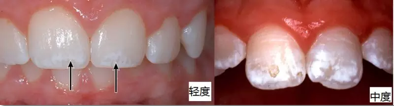 寶寶不能用含氟牙膏嗎 寶寶用含氟牙膏中毒是真的嗎2018