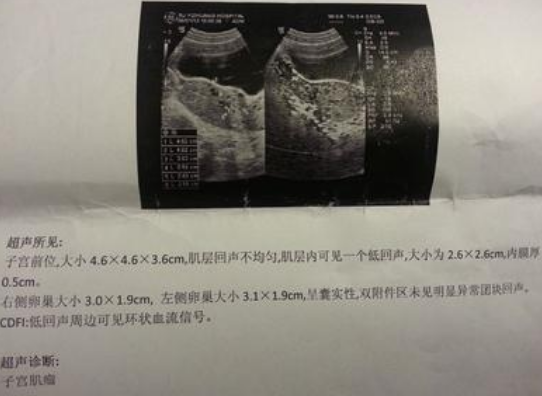 子宮肌瘤對懷孕影響大 檢查出子宮肌瘤還能生小孩嗎 子宮肌瘤對懷孕影響大 檢查出子宮肌瘤還能生小孩嗎