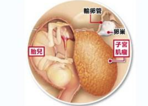 懷孕子宮肌瘤的常見癥狀 子宮肌瘤會引起不孕癥嗎 懷孕子宮肌瘤的常見癥狀 子宮肌瘤會引起不孕癥嗎