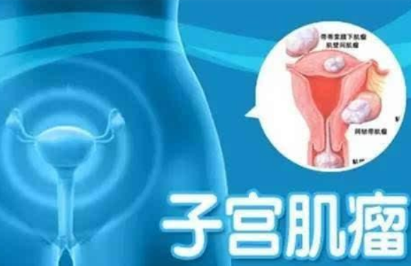 晚生孩子更容易患子宮肌瘤嗎 患子宮肌瘤的高危險(xiǎn)群有哪些