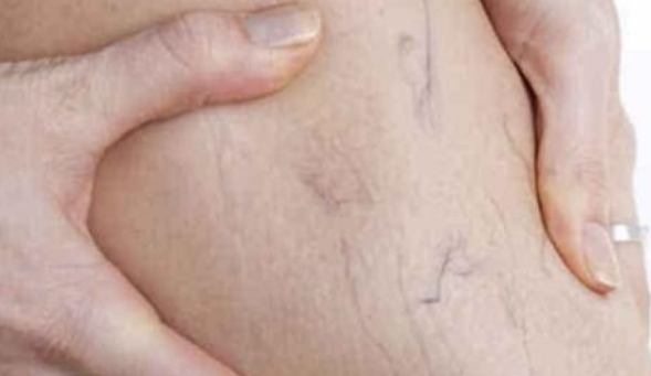 孕婦靜脈曲張原因是什么 孕婦靜脈曲張怎么預防緩解