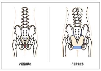 產(chǎn)后骨盆矯正帶有用嗎 骨盆矯正帶怎么用有效2018