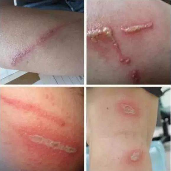 被隱翅蟲叮了怎么辦 怎么預防被隱翅蟲叮2018 被隱翅蟲叮了怎么辦 怎么預防被隱翅蟲叮2018