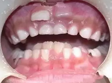 孩子長(zhǎng)雙排牙是怎么回事 怎么避免孩子長(zhǎng)雙排牙
