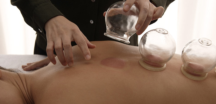 三伏天拔罐要注意什么 哪些人不宜拔罐2018