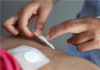 貼三伏貼起泡發紅正常嗎 貼三伏貼起泡需要怎樣處理