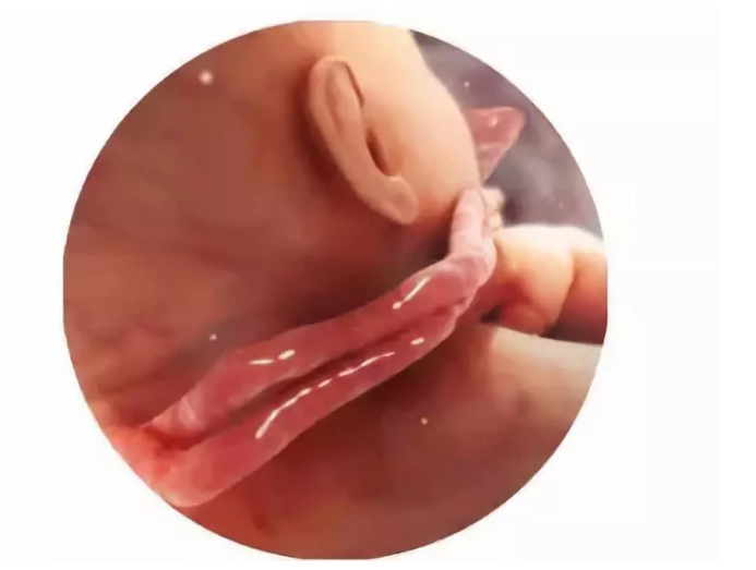 臍帶繞頸一周危險嗎 蔣勤勤寶寶臍帶繞頸一周怎么辦