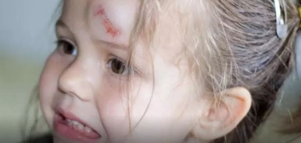 寶寶撞到頭腦震蕩怎么辦 如何治療腦震蕩