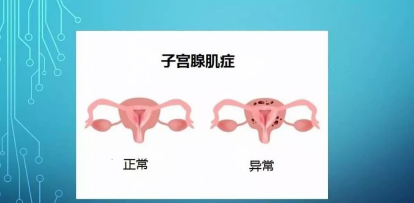 子宮肌腺癥可以做試管嬰兒嗎 子宮肌腺癥做試管嬰兒成功率多少