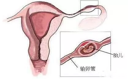 女性宮外孕避免得了嗎 如何預防宮外孕的發生