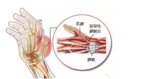 媽媽手是什么病 怎么判斷是不是得了媽媽手