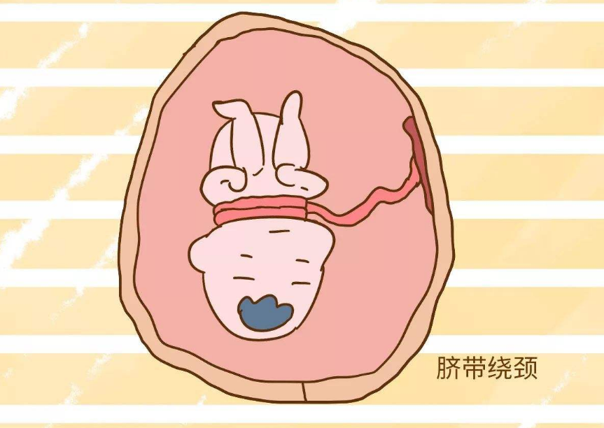 懷孕的時候怎么做可以避免臍帶繞頸 胎兒臍帶繞頸怎么緩解