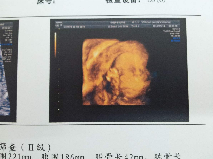 懷孕的時候怎么做可以避免臍帶繞頸 胎兒臍帶繞頸怎么緩解