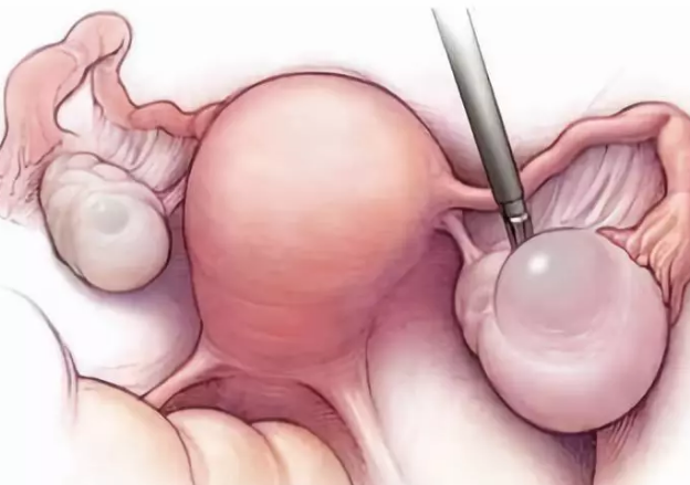 輸卵管積水能做試管嬰兒嗎 輸卵管積水怎么預(yù)防2018