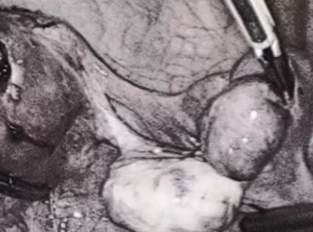 輸卵管有積水會影響胚胎移植嗎 輸卵管積水會影響胚胎移植成功率嗎