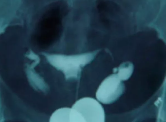 輸卵管有積水會影響胚胎移植嗎 輸卵管積水會影響胚胎移植成功率嗎