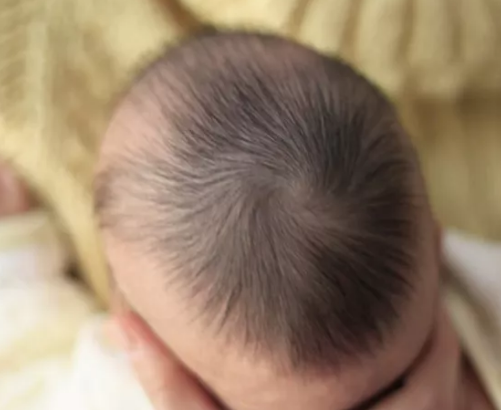 寶寶出現(xiàn)枕禿是因為缺鈣嗎 寶寶枕禿多大會長齊