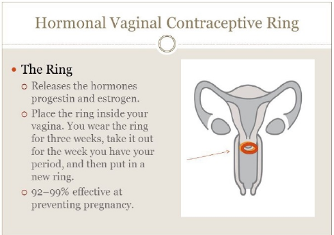 女用長效避孕環(huán)避孕原理是什么 女用長效避孕環(huán)為什么放進(jìn)去就能避孕