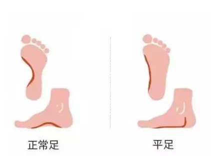 怎么知道寶寶是不是扁平足 怎么預防寶寶扁平足