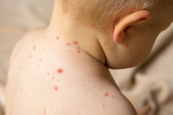 孩子上小學怎么預防水痘  小孩小學得了水痘怎么辦