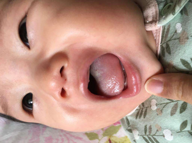 孩子鵝口瘡停藥后就反復怎么辦 孩子鵝口瘡正確護理方法