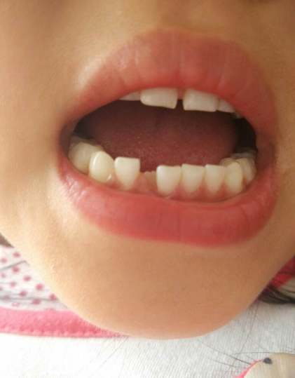 孩子的乳牙不整齊要不要矯正 孩子牙齒不整齊什么時候矯正比較好