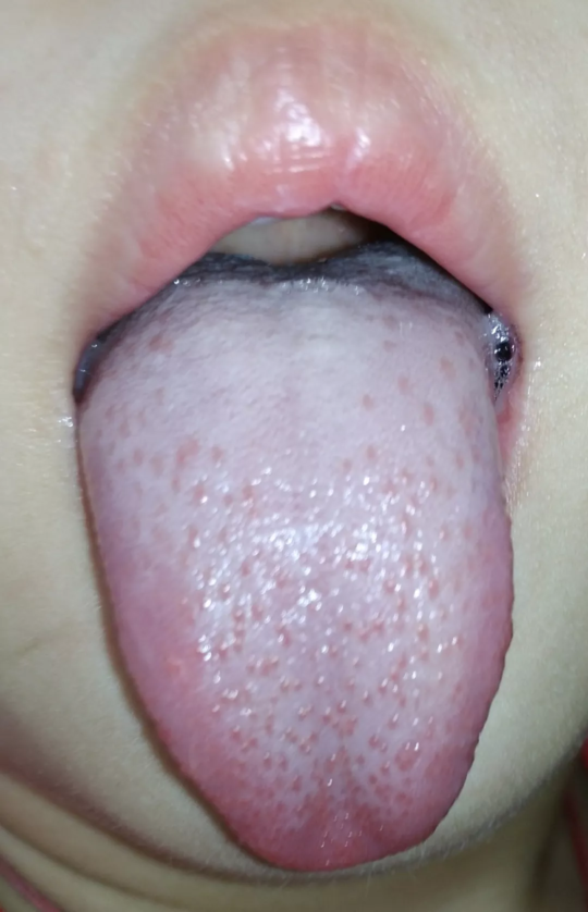 孩子積食用什么方法調(diào)理好 孩子積食嚴(yán)重吃什么改善 孩子積食用什么方法調(diào)理好 孩子積食嚴(yán)重吃什么改善