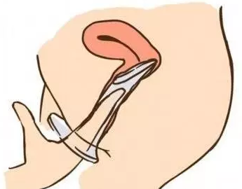 女用避孕套好用嗎 女用避孕套怎么用