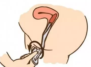 女用避孕套好用嗎 女用避孕套怎么用