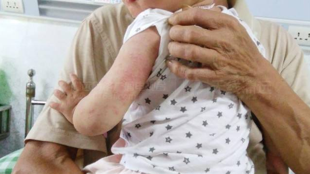 孩子皰疹性咽峽炎是什么病 孩子皰疹性咽峽炎怎么治療