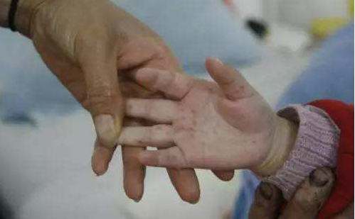 孩子得新型手足口病怎么護理好 孩子新型手足口病正確護理方法