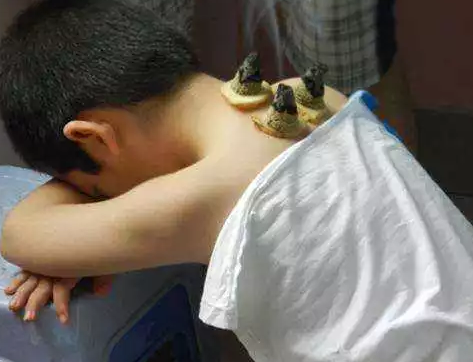 小兒預防感冒艾灸哪里 兒童感冒后溫灸方法