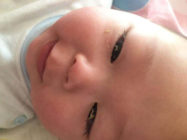 孩子睡醒后眼屎多是什么原因 孩子眼屎多是生病了嗎