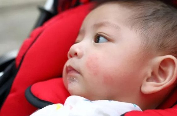 寶寶皮膚過敏的癥狀有哪些   寶寶皮膚過敏癥狀大全