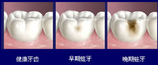 嬰兒期如何預防蛀牙 蛀牙是怎么來的