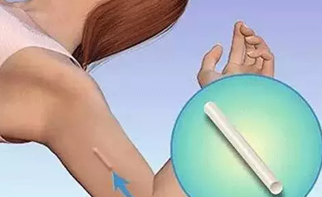 埋線避孕安全性高嗎 埋線避孕效果好不好