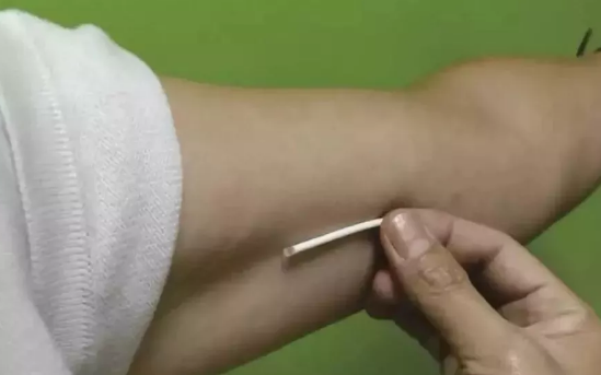 哪些人適合做埋線避孕 哪些人不適合做皮下埋線避孕