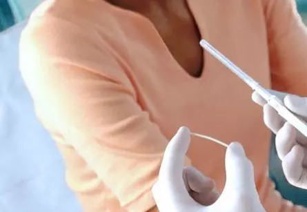 埋線避孕取出來多久能懷孕 埋線避孕可以避孕多久