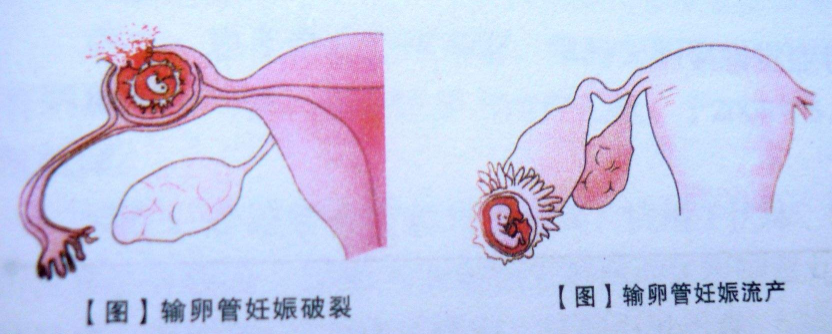 宮角妊娠出血了怎么辦 宮角妊娠出血怎么處理 宮角妊娠出血了怎么辦 宮角妊娠出血怎么處理