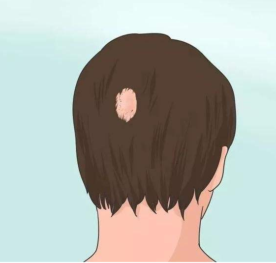 孩子有拔毛癖怎么辦 什么是拔毛癖