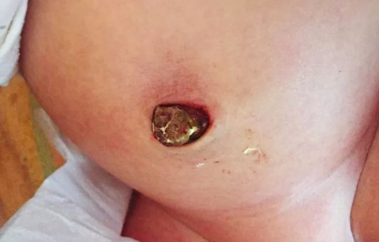 新生兒肚臍發(fā)炎怎么辦 新生兒肚臍護(hù)理需要注意哪方面的問(wèn)題