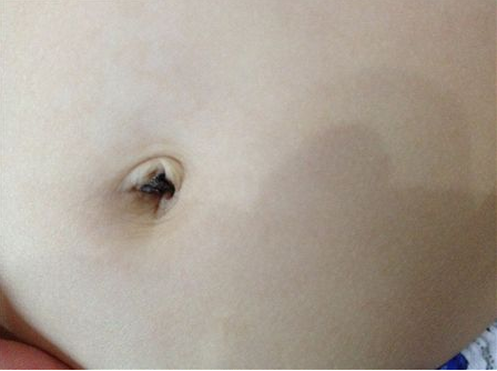 新生兒肚臍發(fā)炎怎么辦 新生兒肚臍護(hù)理需要注意哪方面的問(wèn)題